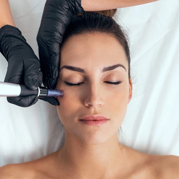 Microneedling aesthetic treatment available at SnB Aesthetic Clinic in Dubai UAE